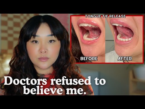 Doctors Missed This for Years—Autism, Chronic Pain & Tongue Ties