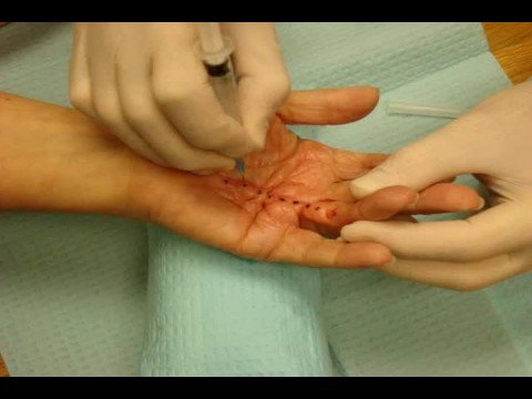 Needle Fasciotomy / Needle Aponeurotomy for Dupuytren's Contracture