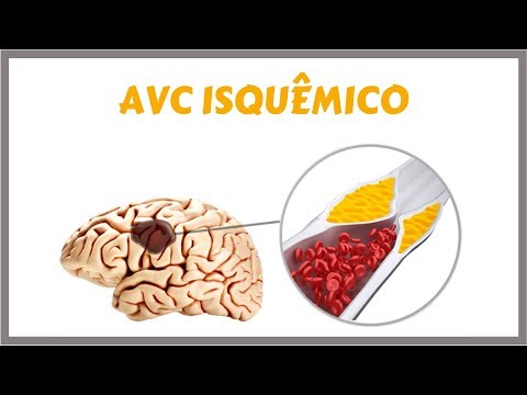Acidente Vascular Cerebral Isquêmico - AVCI