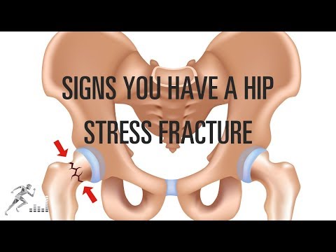 Femoral neck stress fracture: Signs, symptoms, diagnosis, and treatment