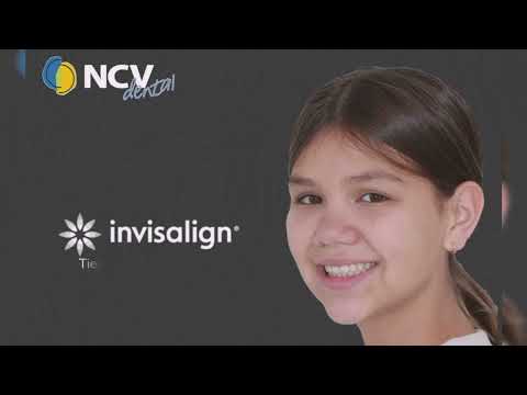 Invisalign - Ortodoncia invisible - Tratamiento de 6 meses