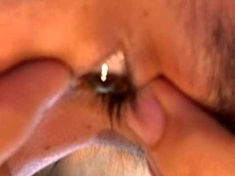 Extraction of a DRL