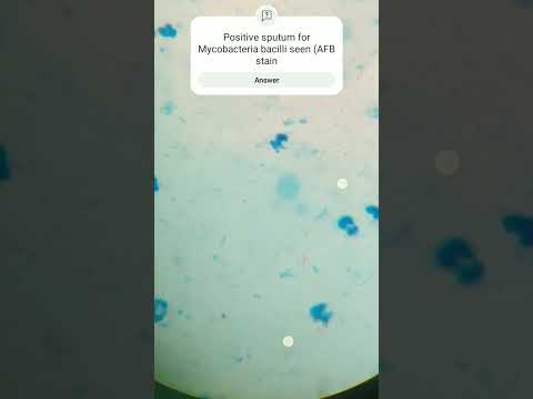 Positive sputum for Mycobacteria bacilli