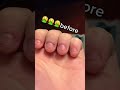 NAIL BITING JOURNEY        #day4,