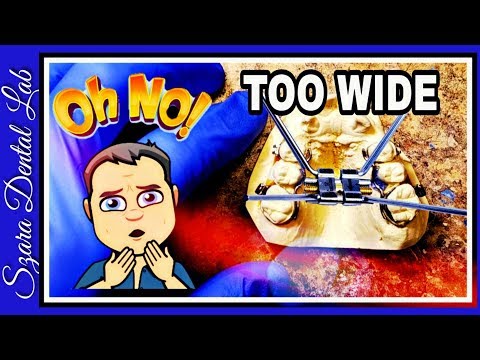 Orthodontic Expander Lab Lesson  by Szara Dental Lab