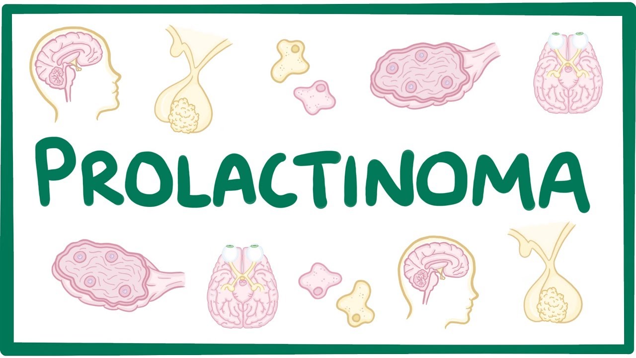 Prolactinoma - causes, symptoms, diagnosis, treatment, pathology - YouTube