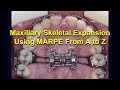 Maxillary Skeletal Expansion Using MARPE From A To Z Updated