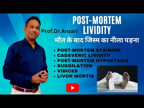 Post-mortem lividity | Cadaveric lividity | Suggilation | Vibices | Livor mortis | Staining