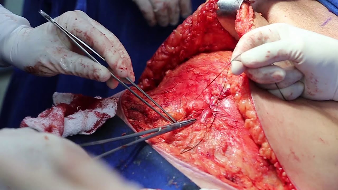 Correção cirúrgica da diastase dos retos abdominais / diastasis of the rectus abdominis