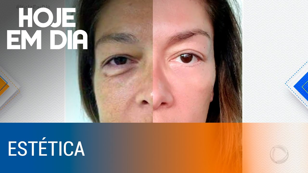 Bioestimuladores de colágeno fazem sucesso entre as famosas