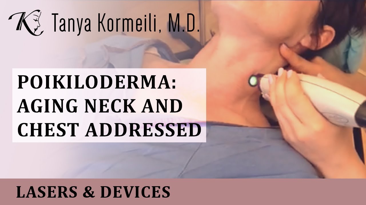 Poikiloderma: Aging Neck and Chest addressed! - YouTube