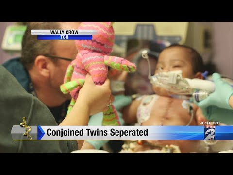 Anniversary of separating conjoined twins
