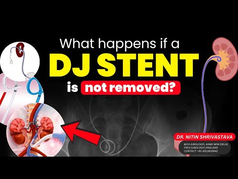 What Happens If a DJ Stent Is Not Removed on Time?