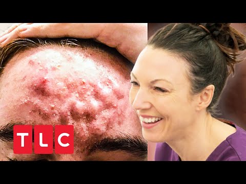 Severe acne on the scalp | Dr. Emma: Dermatologist with passion | TLC Germany