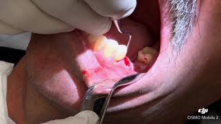Extraction of an infected tooth and grafting with PRF
