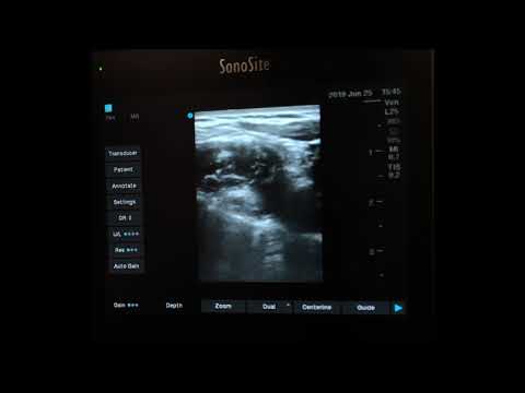 Ultrasound-Guided Interscalene Brachial Plexus Block