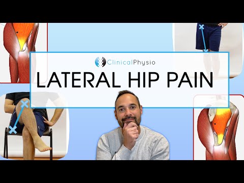What Causes Lateral Hip Pain? | Expert Physio Reviews Causes And Treatment