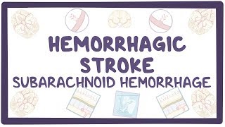 Hemorrhagic stroke, subarachnoid hemorrhage - causes, symptoms, diagnosis, treatment, pathology