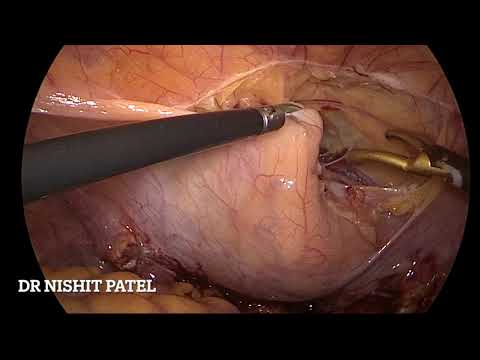 laparoscopic ureteric reimplatation for uretero vaginal fistula ( Dr Nishit Patel)