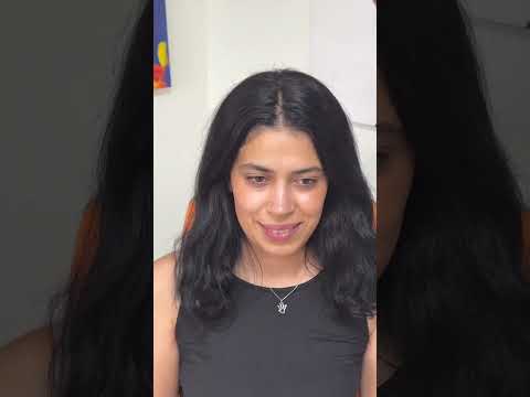 Rhinoplasty Before and After in Turkey/Antalya #rhinoplastyturkey