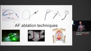 Catheter Ablation for Atrial Fibrillation – Dr Anderi Catanchin