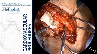 Download Lagu Carotid Bypass after Failure of Temporary Balloon Occlusion (Lumsden, MD, Garami, MD, Vowels, MD) Thumbnail