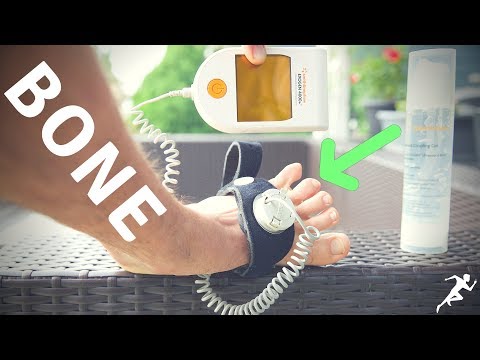 Healing Bone Injuries for Runners | Exogen Ultrasound Bone Healing System