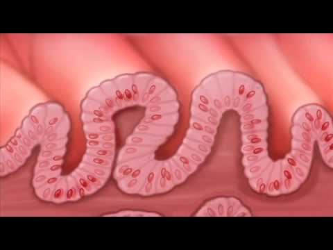 What is Barretts Esophagus?-Mayo Clinic