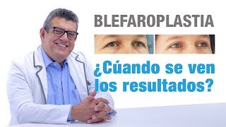 Cuándo se ven los resultados de la Blefaroplastia |  Clínicas Diego de León