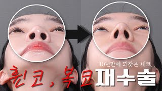 [코재수술 인터뷰] 서아편_L자 실리콘 제거&휜코,복코코재수술