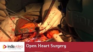 Open Heart Surgery, Lisie Hospital 