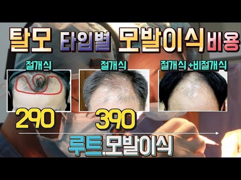 M자헤어라인탈모  모발이식 비용 290만원 진행된 탈모증상별 모발이식가격소개