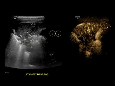 Consolidation vs Pleural Effusion