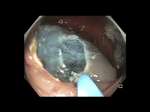 Colonoscopy: Ascending Colon 25 mm Polyp EMR - Injection Makes It Easy to Cut