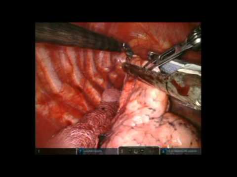 Robotic Pleurectomy And Pleurodesis