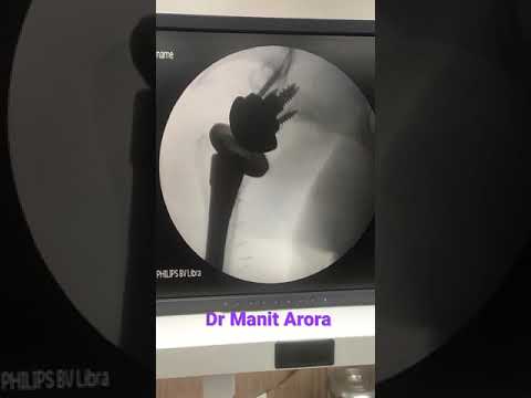 AMAZING LIVE VIDEO! Dr Arora showed me this straight after my shoulder replacement surgery with him!