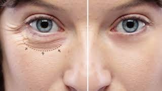 Blepharoplasty Surgery | চোখের সৌন্দর্য ফেরাতে আধুনিক সমাধান!
