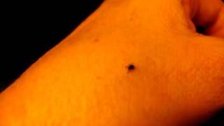 Watching a wood tick wander on my hand &amp; arm