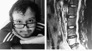 Mi experencia viviendo con una hernia discal. ¿Seguí corriendo | Lalo Vive