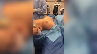 Live Breast Augmentation Surgery video