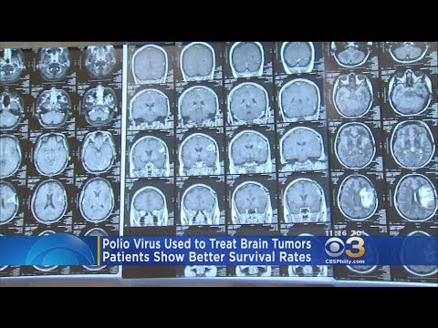 Polio Virus Being Used To Treat Brain Tumors