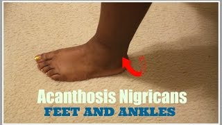 MY ANKLES AND FEET ARE CLEARING FROM DARKNESS CALLED ANCANTHOSIS NIGRICANS
