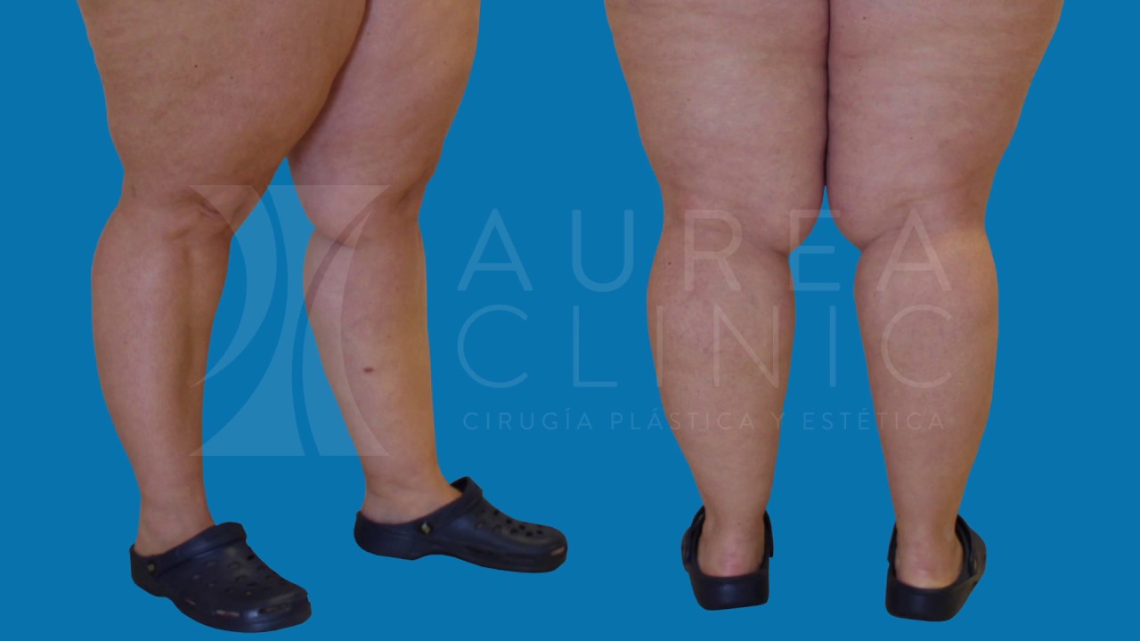 Watch Cirugía de Lipedema con la Doctora Ana Martínez Padilla Now Cirugía de Lipedema con la Doctora Ana Martínez Padilla