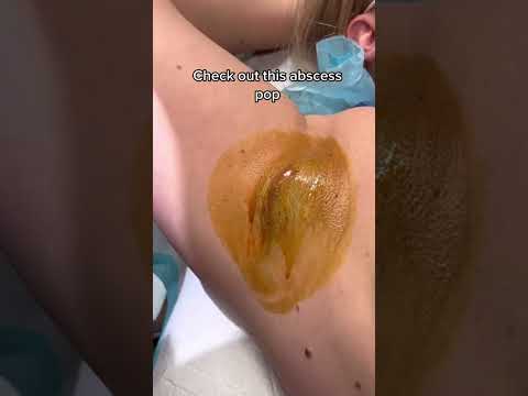 Derm drains MASSIVE armpit abscess! #dermreacts #doctorreacts #abscess