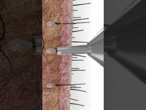 Hair Transplant, Have you had any experience?Video credit: Guncel Ozturk