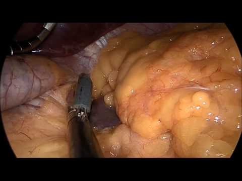 marSeal5 IQ and maXium® – Sleeve gastrectomy