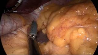 marSeal5 IQ and maXium® | Sleeve gastrectomy