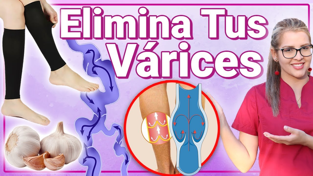 Elimina Tus Várices En 2 Semanas - Cómo Quitar Las Várices O Trombos Y Disminuir Sangre Coagulada