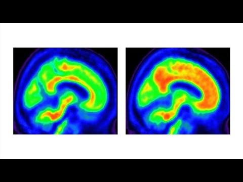 Lack of Vitamin B1 May Lead to Alzheimer's