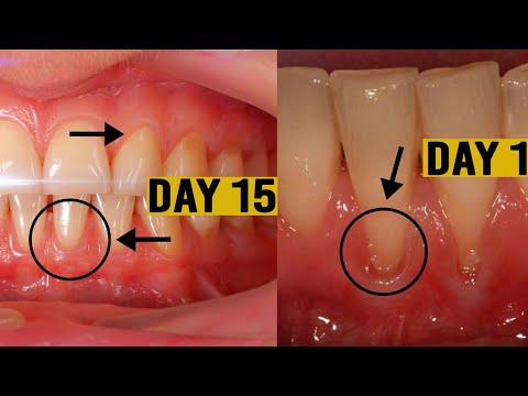 Grow Back Your Receding Gums In Just  2 Week Say Goodbye to Receding Gums